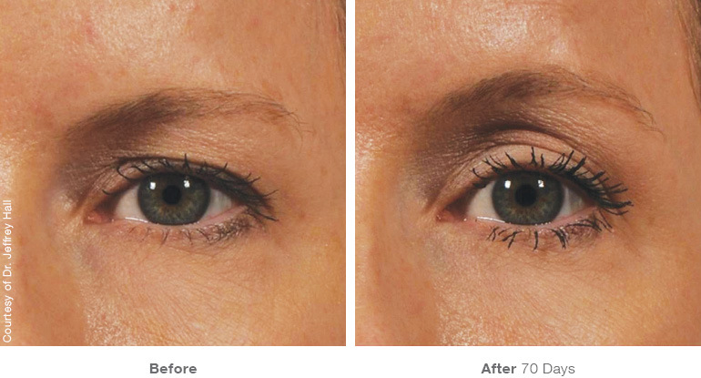 image-689307-img_template_beforeafter_brow12.jpg