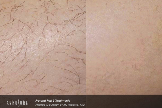laser-hair-removal.png