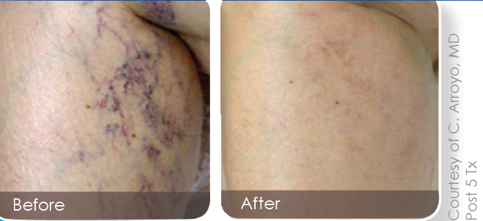 Vein-Removal.png