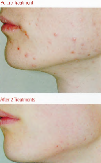 acne.png
